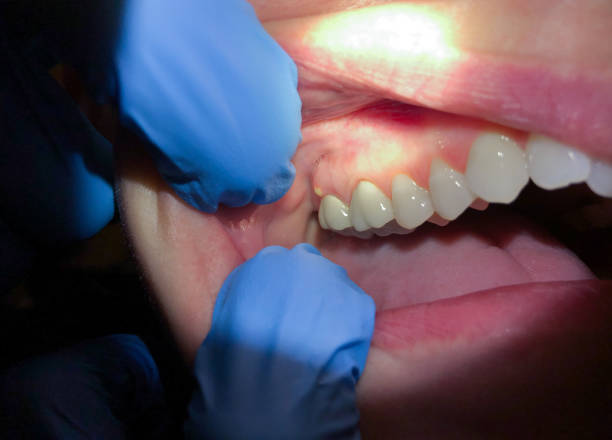 Best Emergency Tooth Extraction in Winston, OR